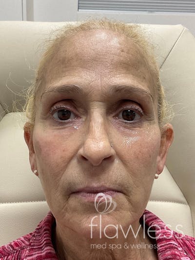 Pico Laser Skin Rejuvenation Before & After Gallery - Patient 176657395 - Image 2