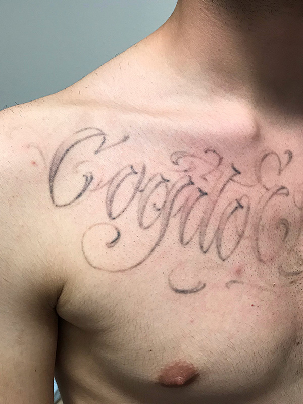 Laser Tattoo Removal Before & After Gallery - Patient 176657400 - Image 1