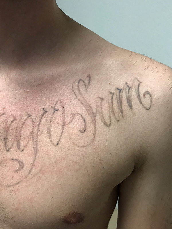 Laser Tattoo Removal Before & After Gallery - Patient 176657400 - Image 3