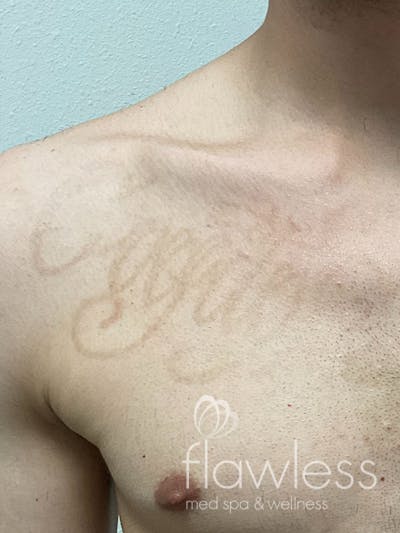 Laser Tattoo Removal Before & After Gallery - Patient 176657400 - Image 2