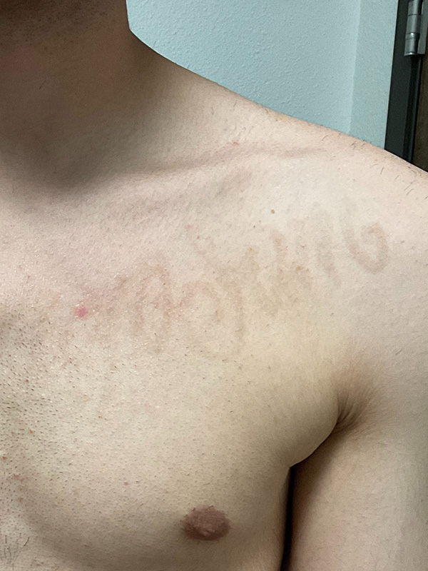 Laser Tattoo Removal Before & After Gallery - Patient 176657400 - Image 4