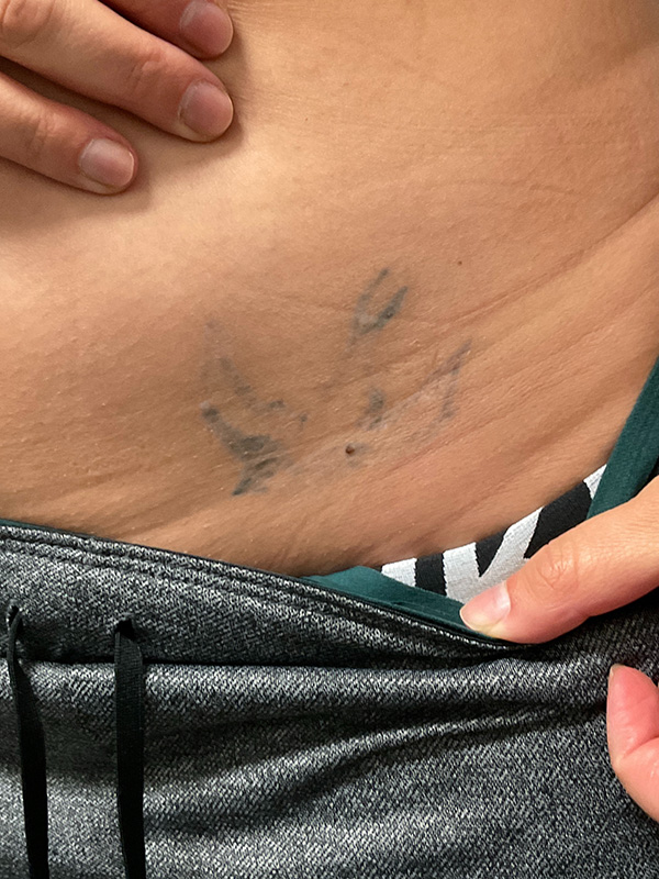 Laser Tattoo Removal Before & After Gallery - Patient 176657399 - Image 2