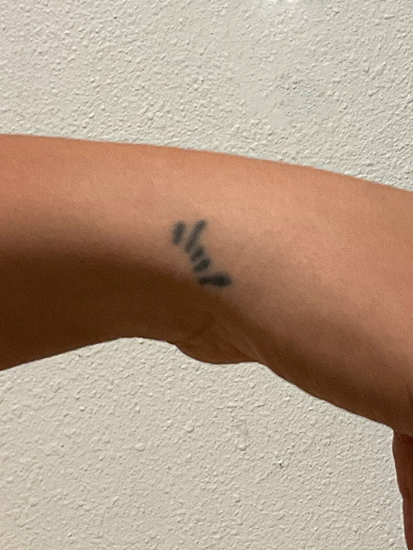 Laser Tattoo Removal Before & After Gallery - Patient 176657398 - Image 1