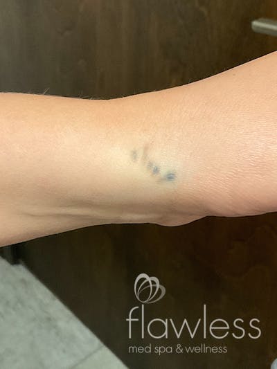 Laser Tattoo Removal Before & After Gallery - Patient 176657398 - Image 2