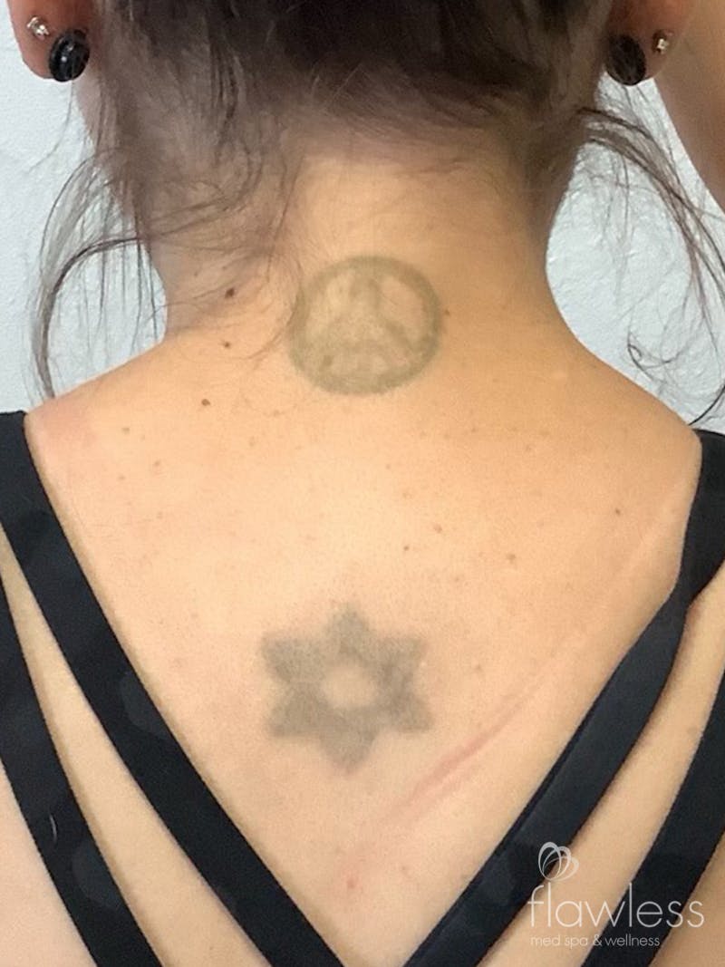 Laser Tattoo Removal Before & After Gallery - Patient 176657401 - Image 1