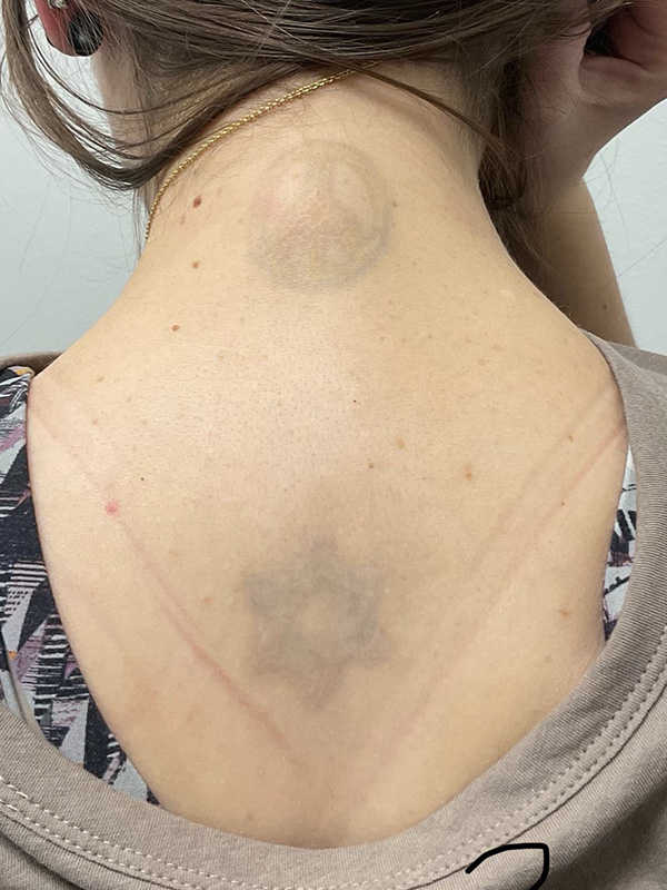 Laser Tattoo Removal Before & After Gallery - Patient 176657401 - Image 2