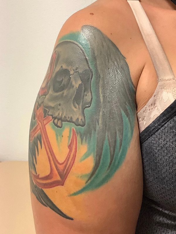 Laser Tattoo Removal Before & After Gallery - Patient 176657402 - Image 1