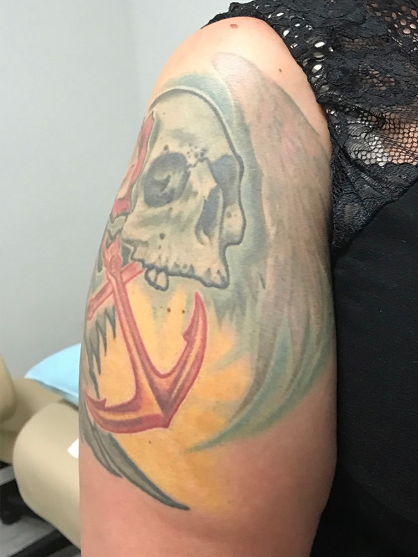 Laser Tattoo Removal Before & After Gallery - Patient 176657402 - Image 2