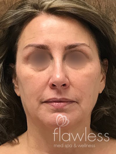 Scarlet RF Microneedling Before & After Gallery - Patient 179750101 - Image 1