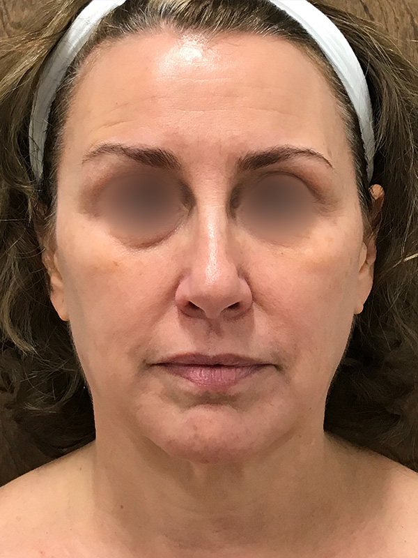 Scarlet RF Microneedling Before & After Gallery - Patient 179750101 - Image 2