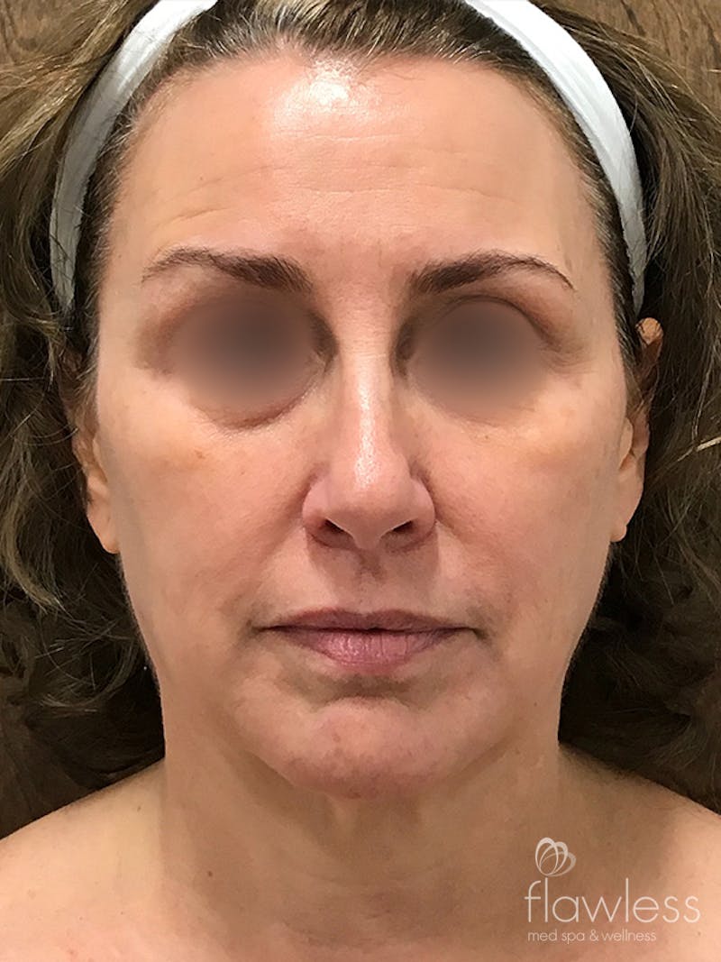 Scarlet RF Microneedling Before & After Gallery - Patient 179750101 - Image 2
