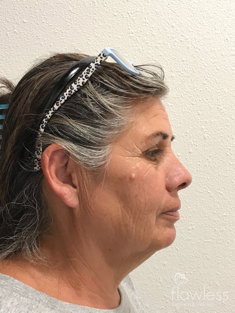 Scarlet RF Microneedling Before & After Gallery - Patient 475347 - Image 3