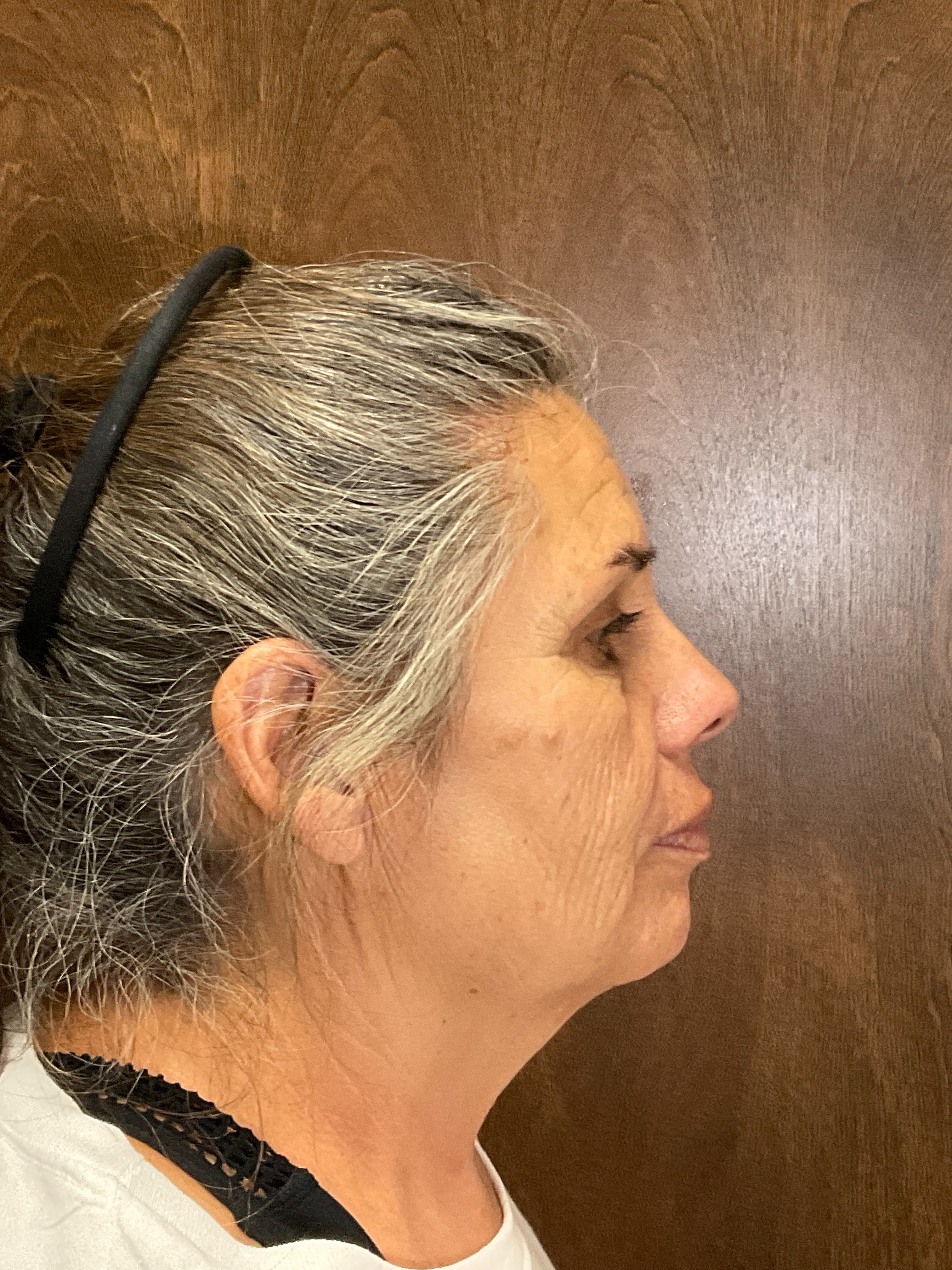 Scarlet RF Microneedling Before & After Gallery - Patient 475347 - Image 4