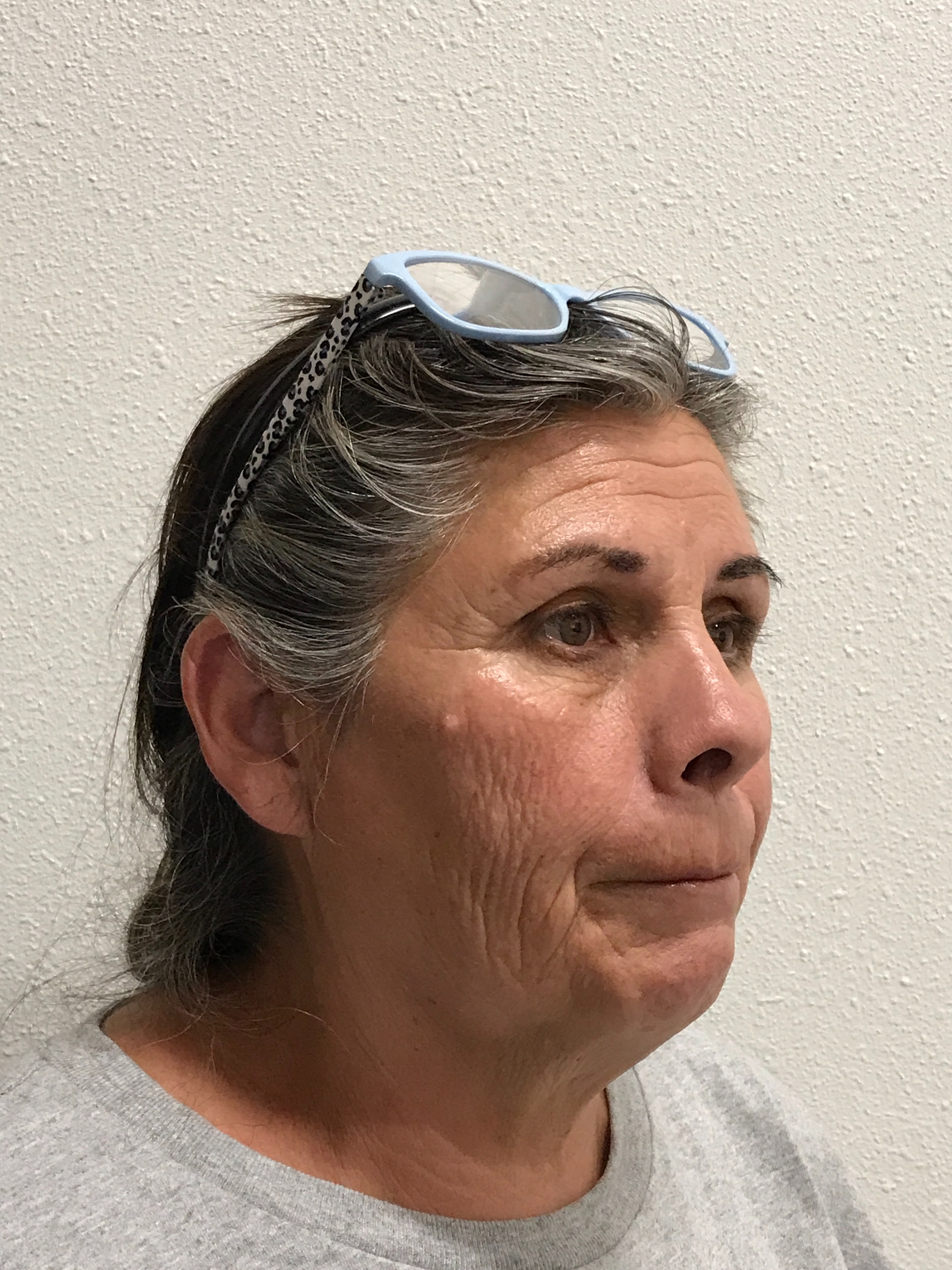 Scarlet RF Microneedling Before & After Gallery - Patient 475347 - Image 5