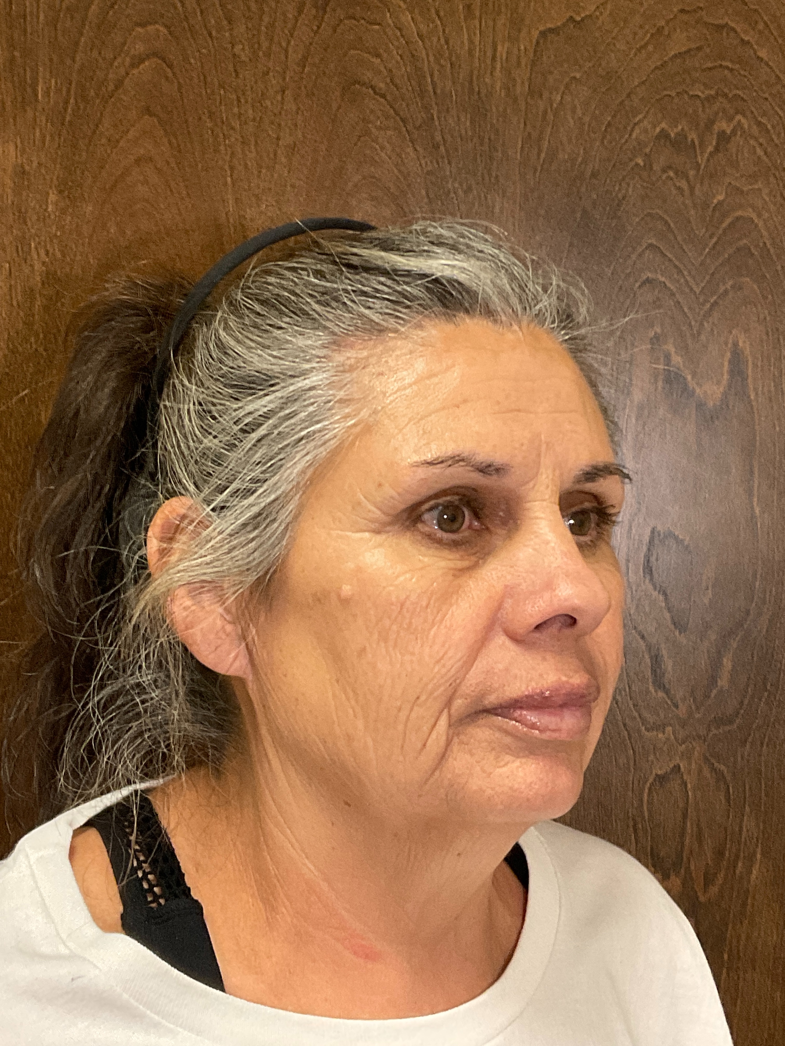 Scarlet RF Microneedling Before & After Gallery - Patient 475347 - Image 6