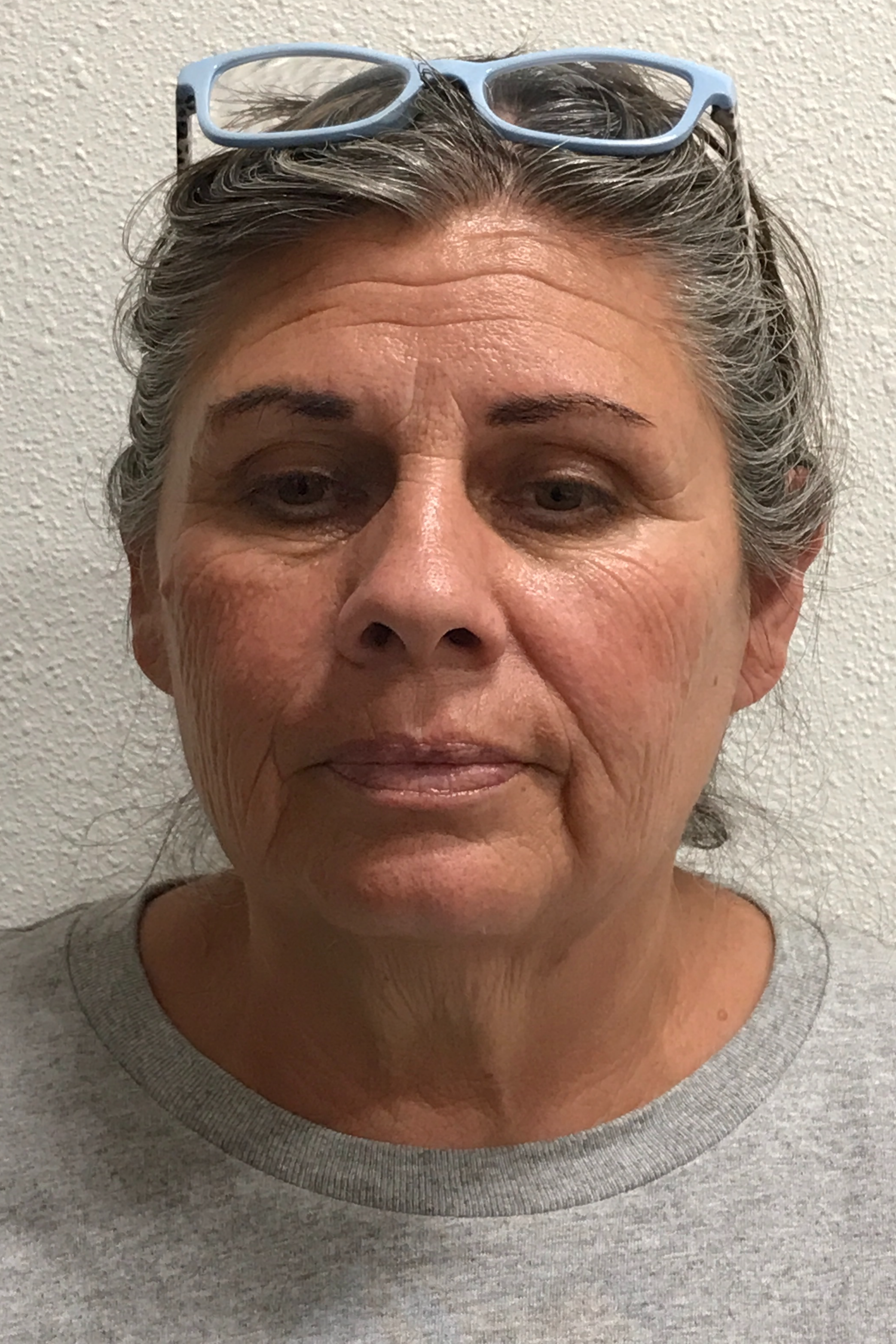 Scarlet RF Microneedling Before & After Gallery - Patient 475347 - Image 1