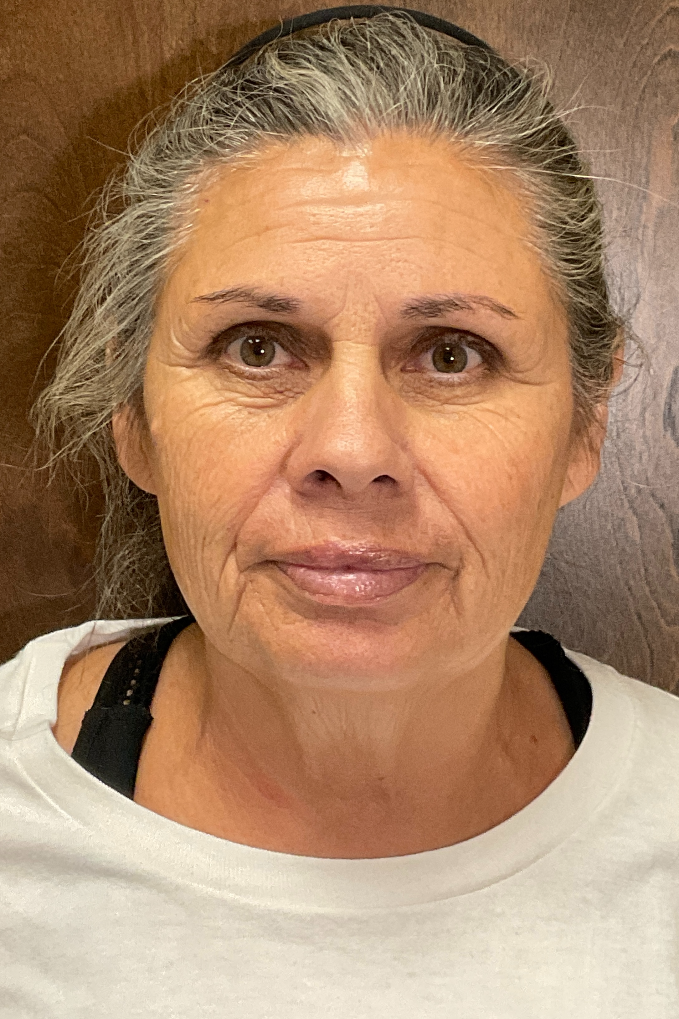 Scarlet RF Microneedling Before & After Gallery - Patient 475347 - Image 2