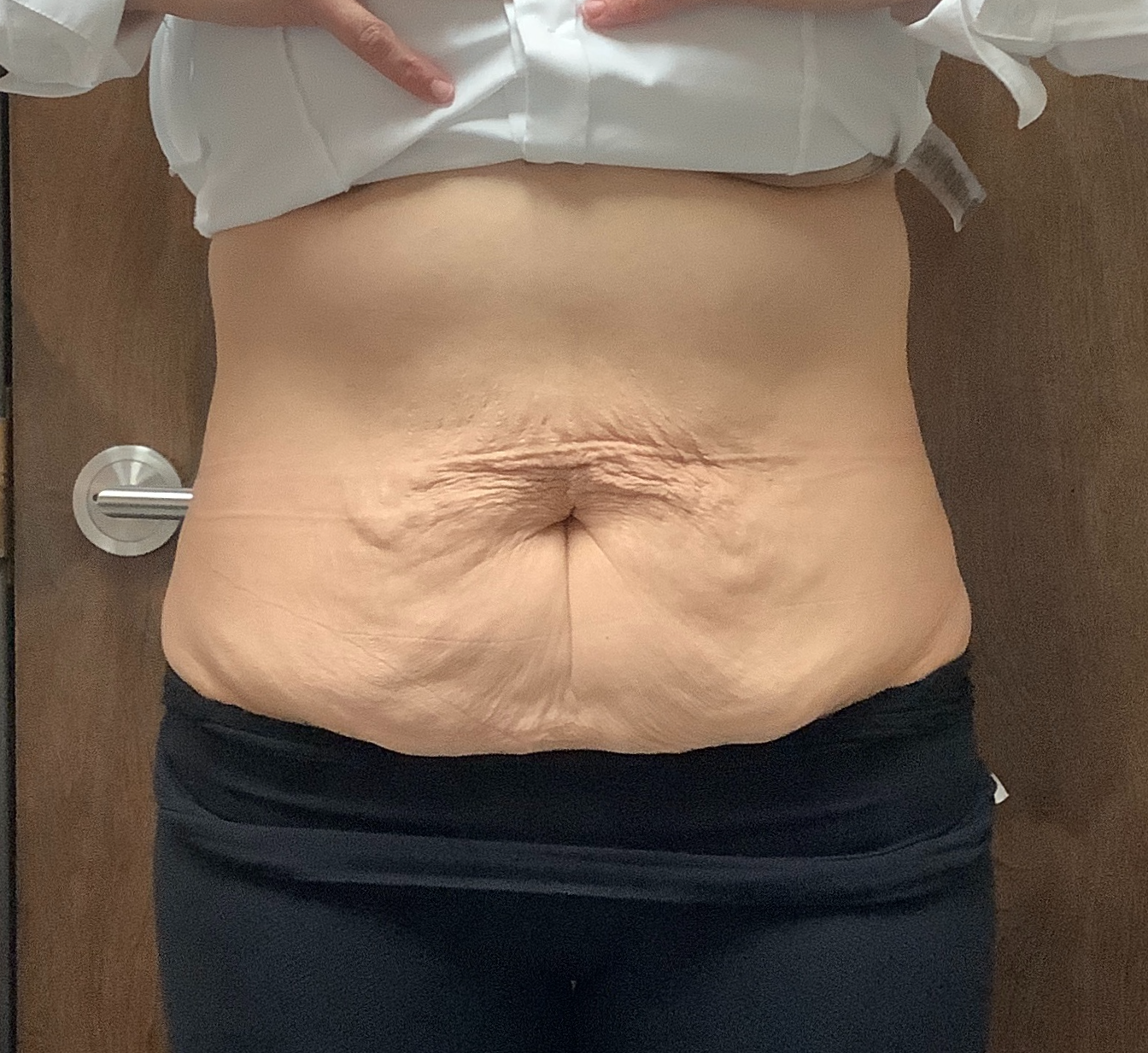 Scarlet RF Microneedling Before & After Gallery - Patient 428123 - Image 2