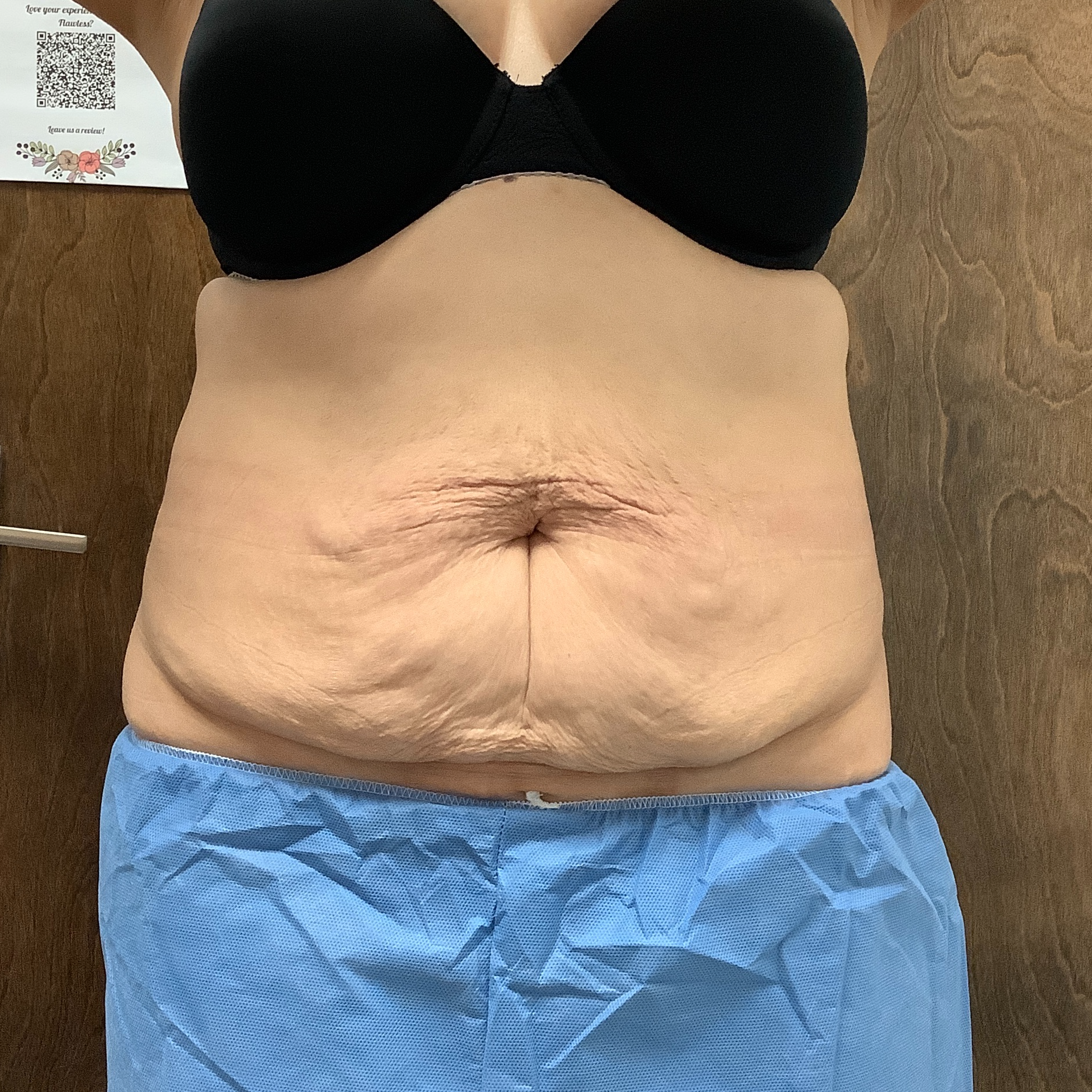 Scarlet RF Microneedling Before & After Gallery - Patient 428123 - Image 1