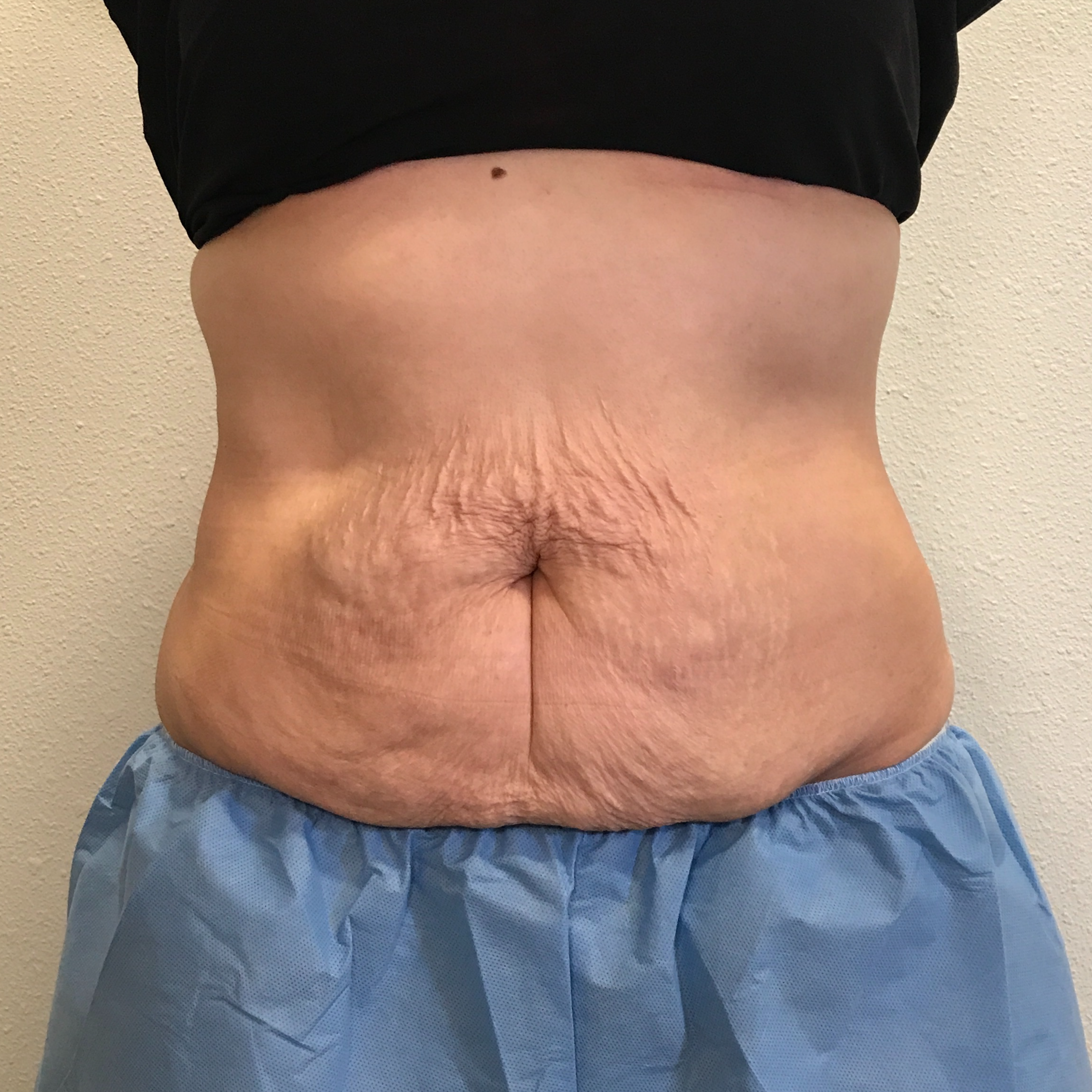 Scarlet RF Microneedling Before & After Gallery - Patient 137941 - Image 1