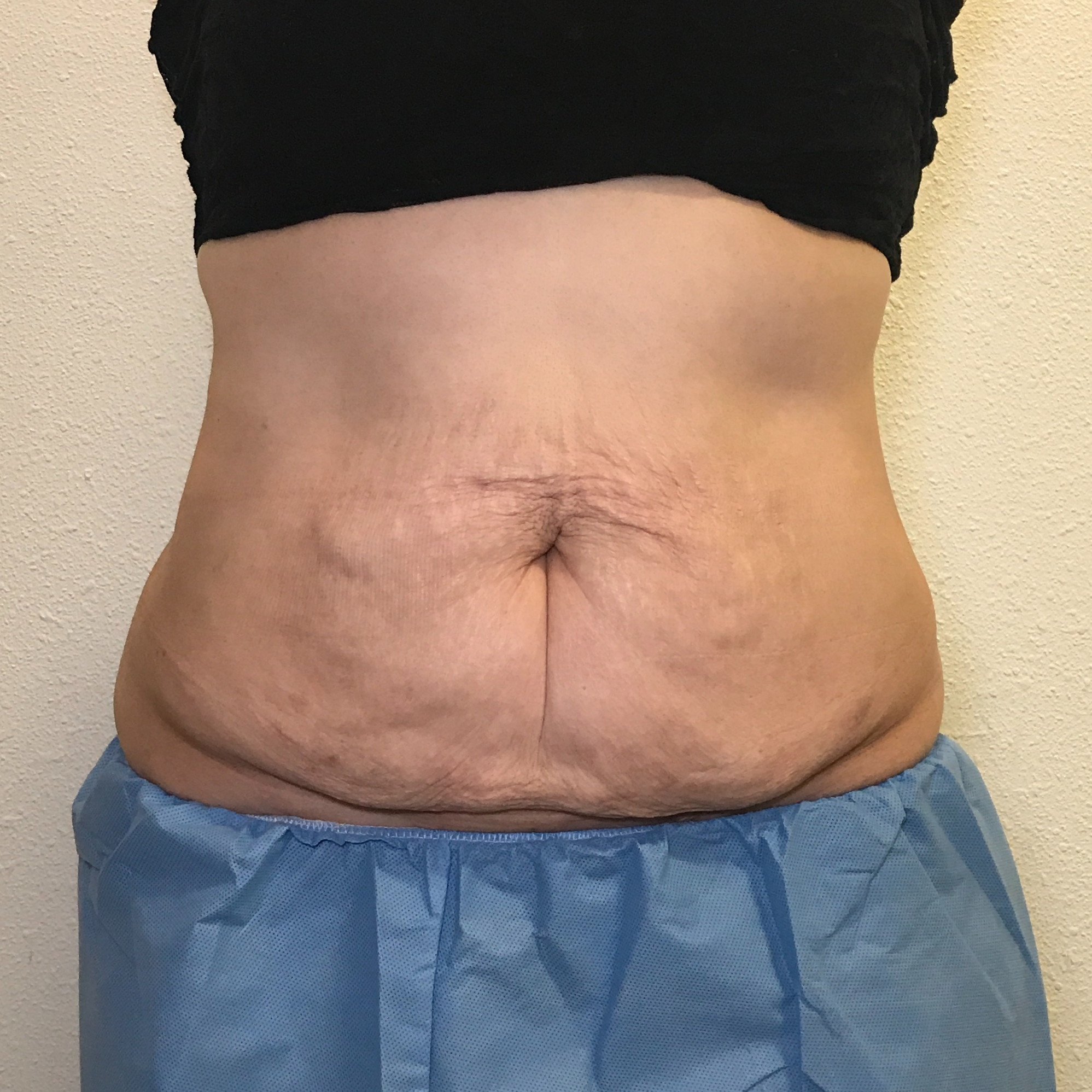 Scarlet RF Microneedling Before & After Gallery - Patient 137941 - Image 2