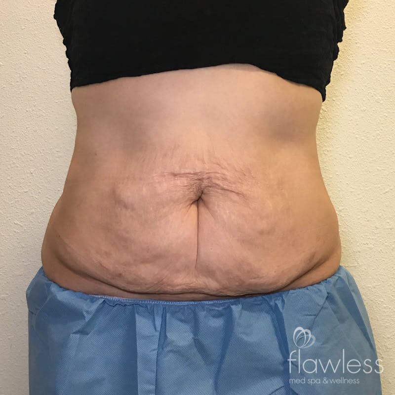 Scarlet RF Microneedling Before & After Gallery - Patient 137941 - Image 2