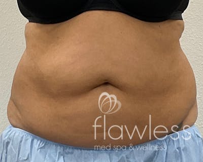 Coolsculpting Before & After Gallery - Patient 106110 - Image 1