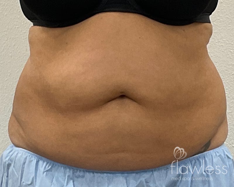 Coolsculpting Before & After Gallery - Patient 106110 - Image 1