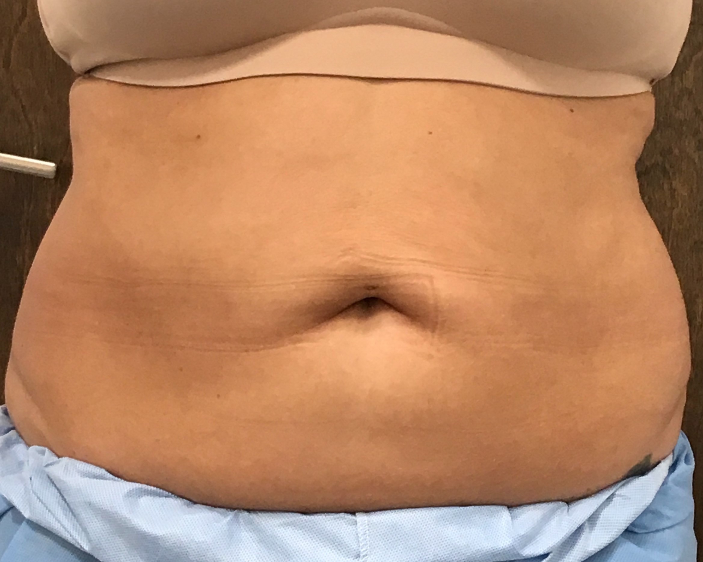 Coolsculpting Before & After Gallery - Patient 106110 - Image 2