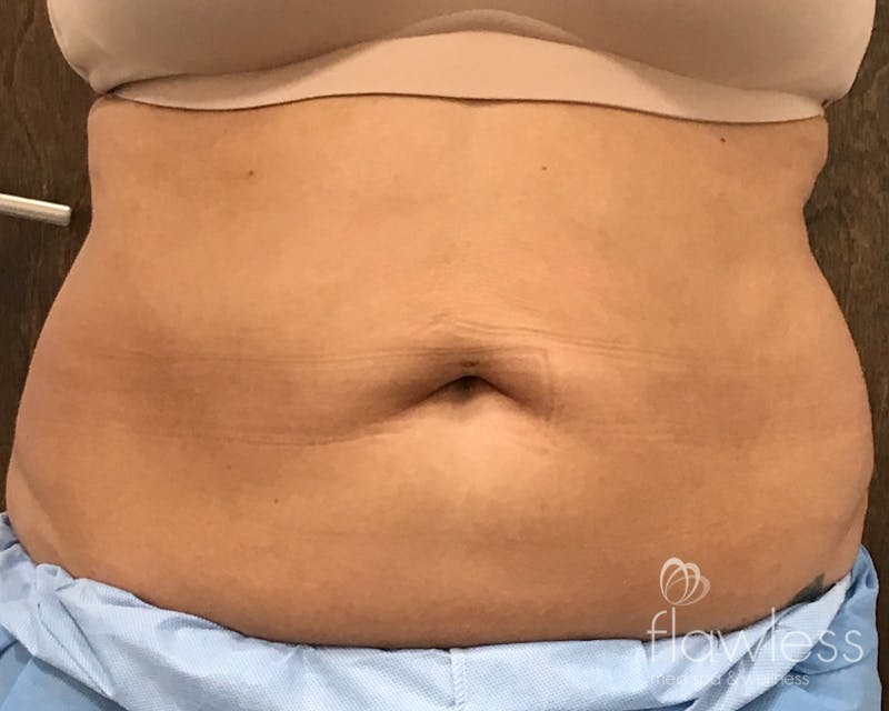 Coolsculpting Before & After Gallery - Patient 106110 - Image 2