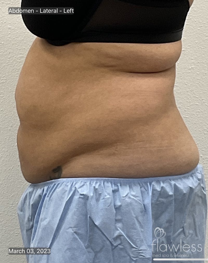 Coolsculpting Before & After Gallery - Patient 106110 - Image 3