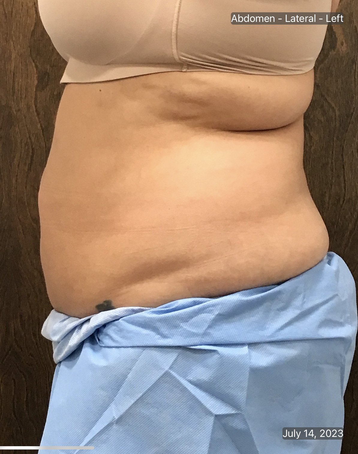 Coolsculpting Before & After Gallery - Patient 106110 - Image 4
