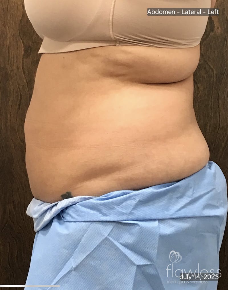 Coolsculpting Before & After Gallery - Patient 106110 - Image 4