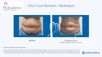 Coolsculpting Before & After Gallery - Patient 585647 - Image 1