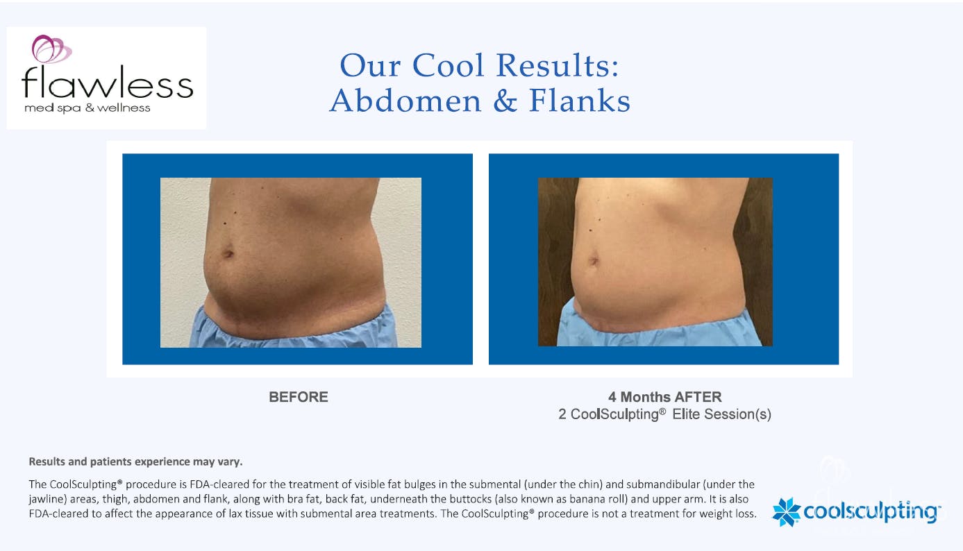 Coolsculpting Before & After Gallery - Patient 220456 - Image 1