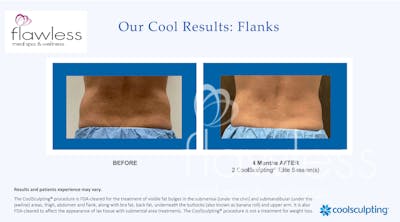 Coolsculpting Before & After Gallery - Patient 185761 - Image 1