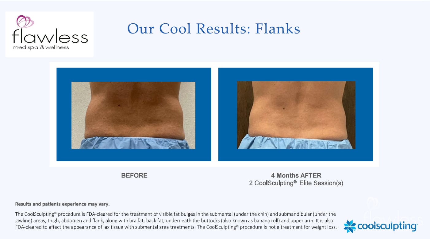 Coolsculpting Before & After Gallery - Patient 185761 - Image 1