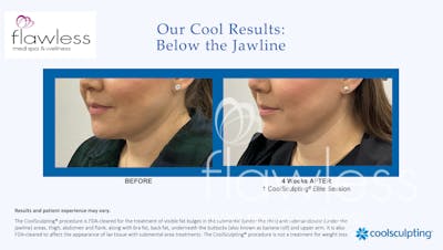 Coolsculpting Before & After Gallery - Patient 170647 - Image 1