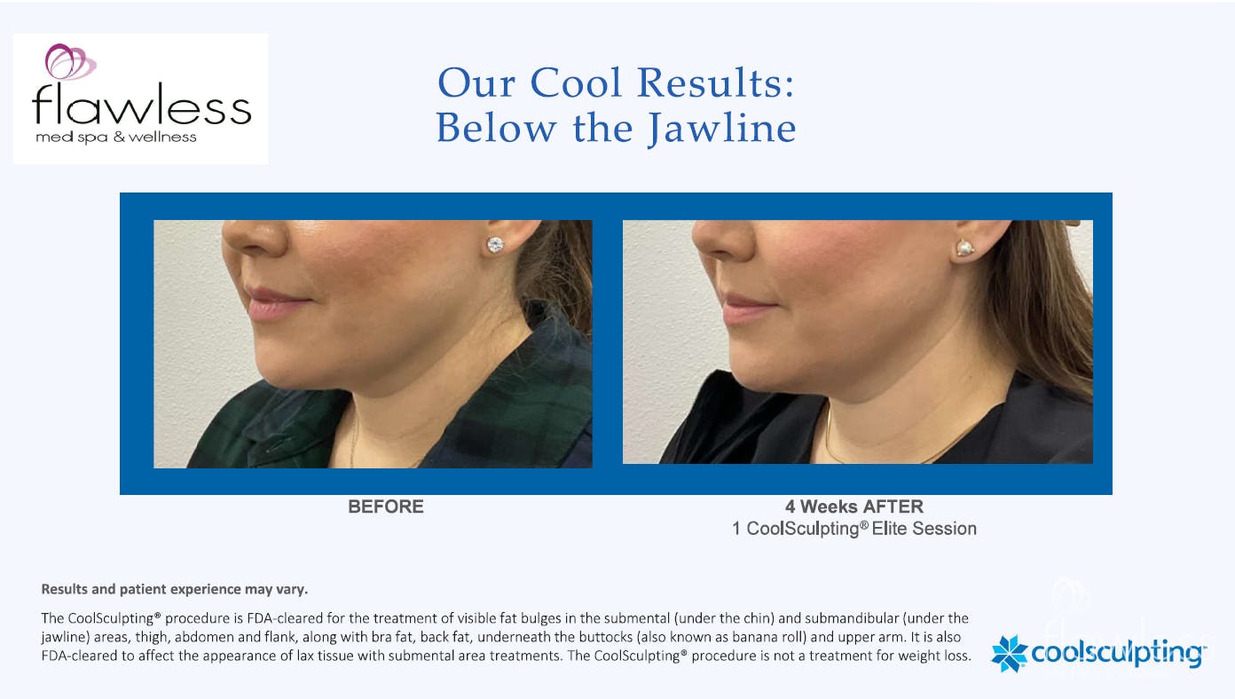 Coolsculpting Before & After Gallery - Patient 170647 - Image 1