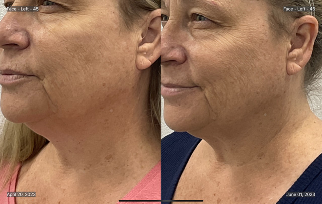 Coolsculpting Before & After Gallery - Patient 855841 - Image 1
