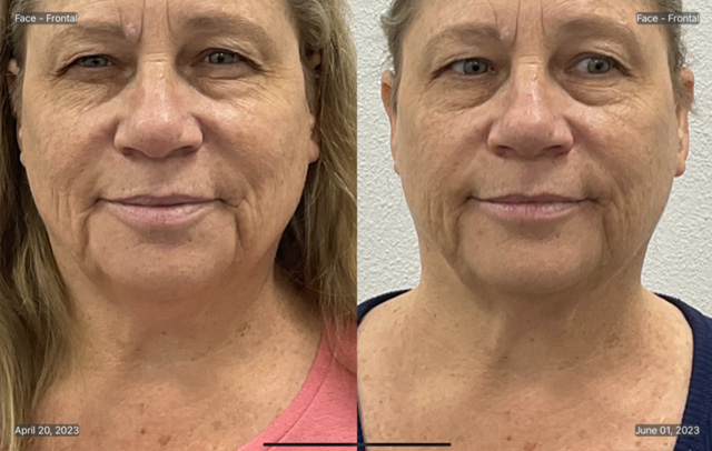 Coolsculpting Before & After Gallery - Patient 855841 - Image 2