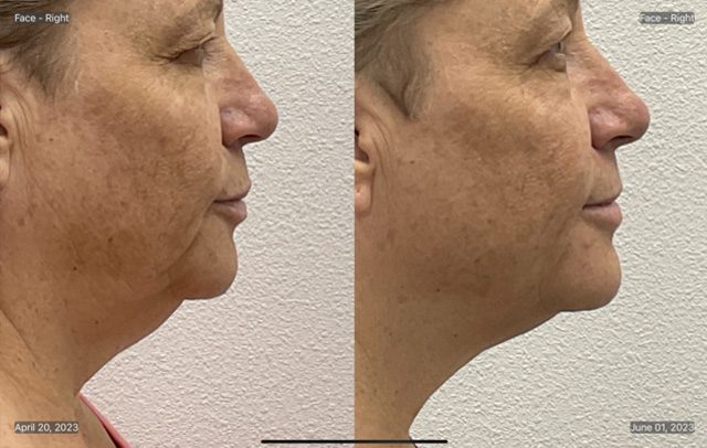 Coolsculpting Before & After Gallery - Patient 855841 - Image 3
