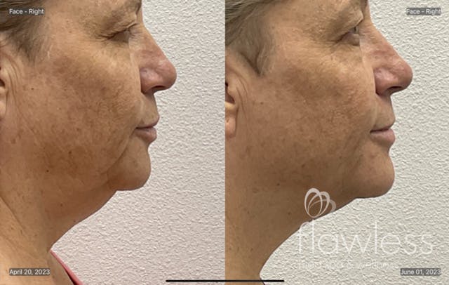 Coolsculpting Before & After Gallery - Patient 855841 - Image 3