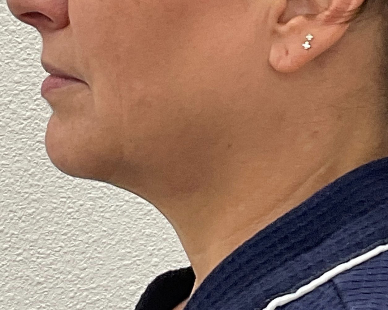 Coolsculpting Before & After Gallery - Patient 283104 - Image 1