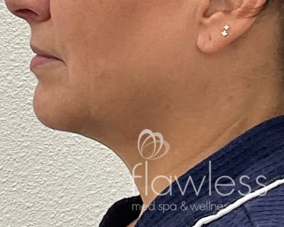 Coolsculpting Before & After Gallery - Patient 283104 - Image 1