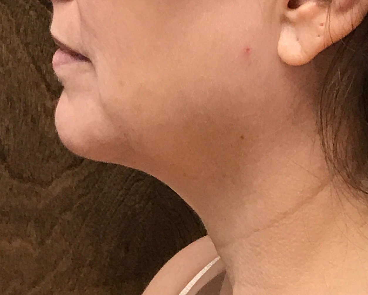 Coolsculpting Before & After Gallery - Patient 283104 - Image 2