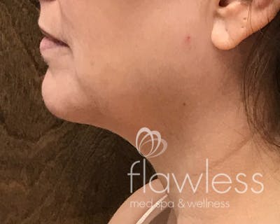 Coolsculpting Before & After Gallery - Patient 283104 - Image 2