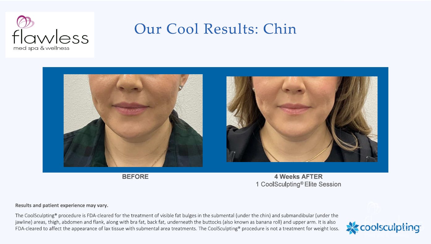 Coolsculpting Before & After Gallery - Patient 312406 - Image 1