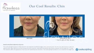 Coolsculpting Before & After Gallery - Patient 312406 - Image 1