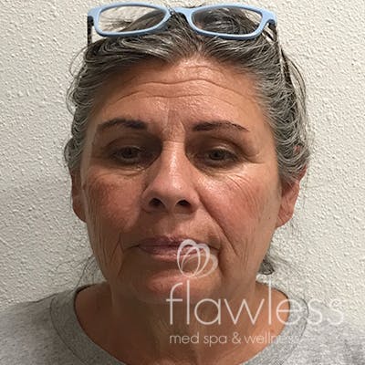 Scarlet RF Microneedling Before & After Gallery - Patient 376140 - Image 1
